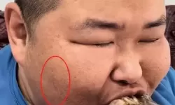 泡泡龙脸上黑斑是什么原因造成的?脸上出现黑斑是癌症吗?