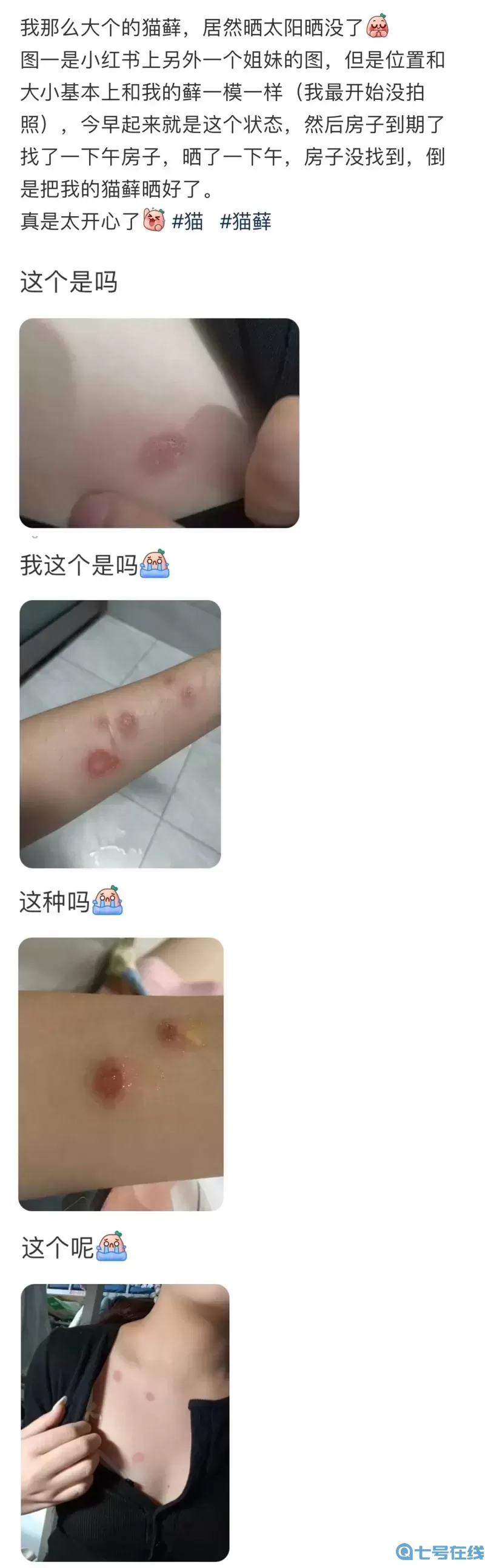 人得猫癣不治疗可以自己痊愈吗